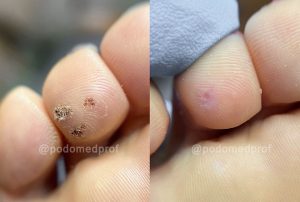 Фото «до и после» пальца ноги: слева — подошвенная бородавка с характерными чёрными точками; справа — чистая кожа после удаления