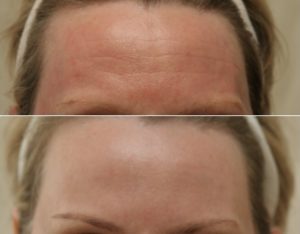 Косметологические услуги по омоложению кожи плазмой в клинике PodoProf Спб