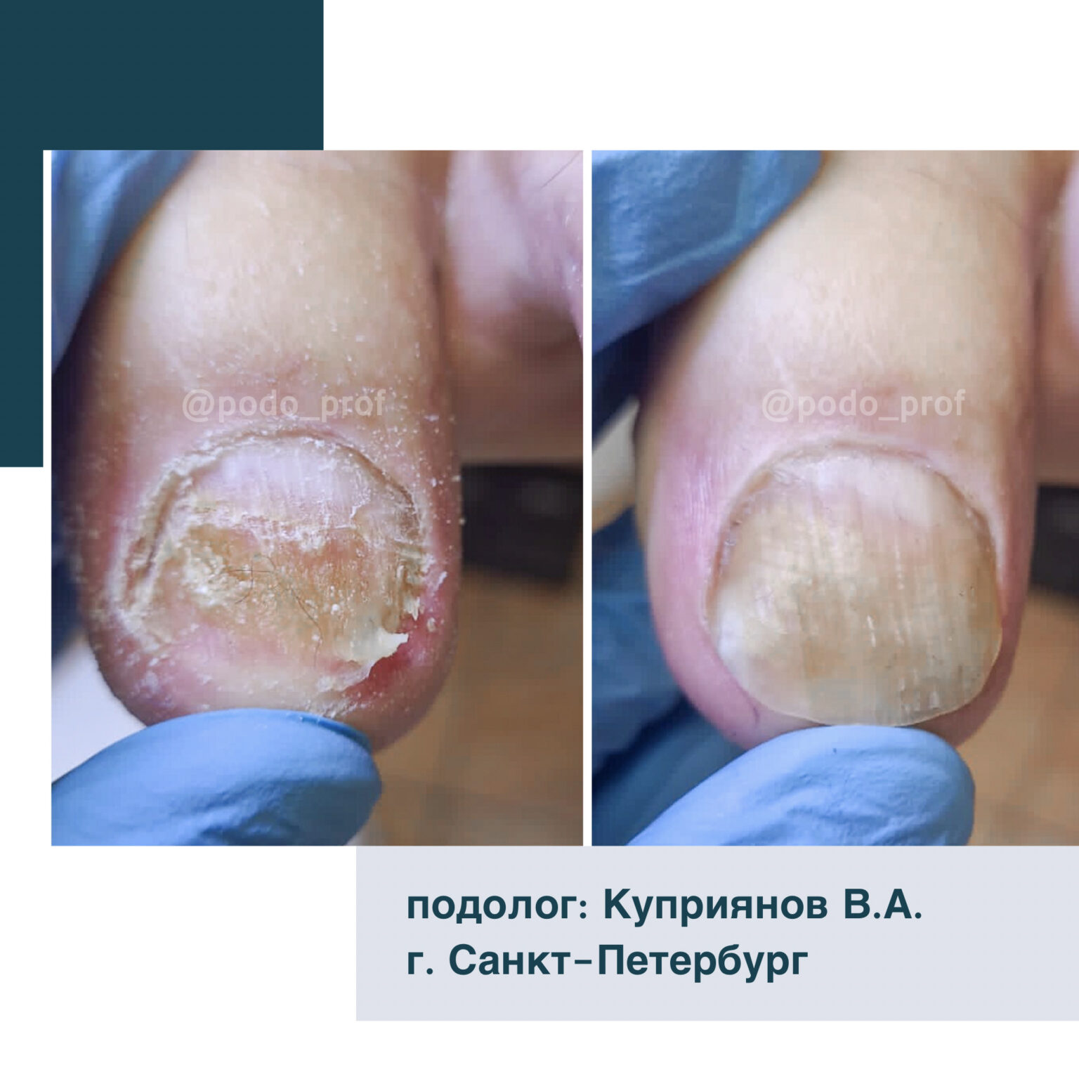 Фотодинамическая обработка грибка ногтей СПБ